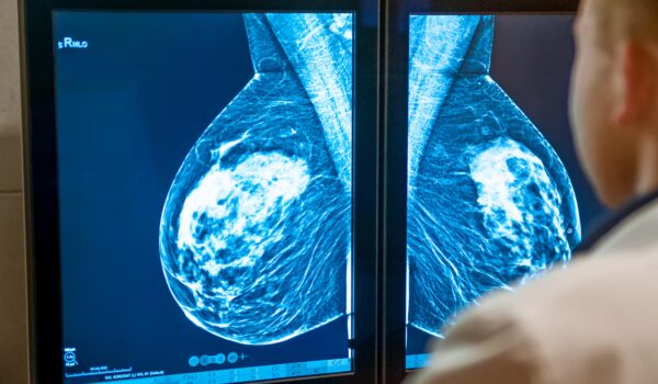 ایمونوتراپی CAR T